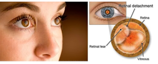 Cara Pengobatan Penyakit Ablasio Retina