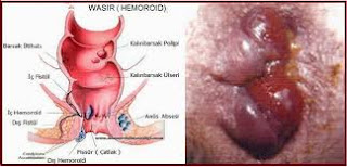 Pengobatan Herbal Ambeien Kronis