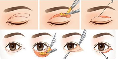 Có nên lấy mỡ mí mắt Có nên lấy mỡ mí mắt