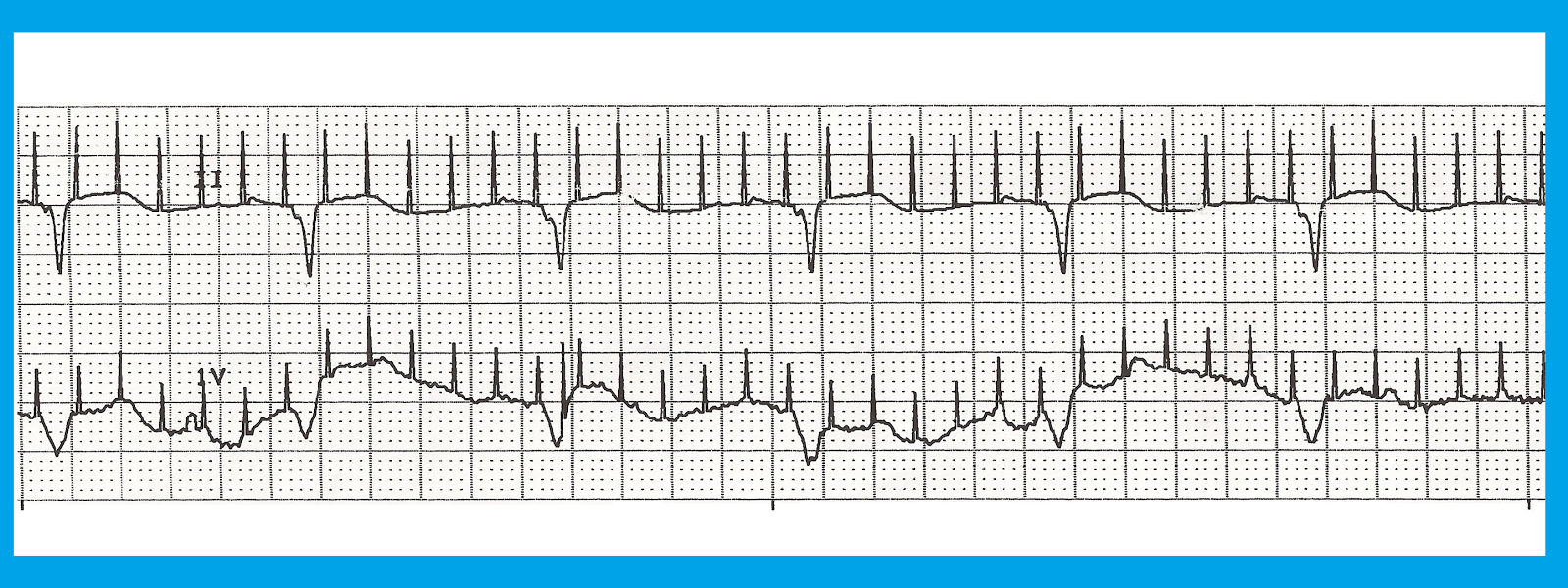 EKG Rhythm Quiz 236