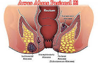 abses perianal abses perianal