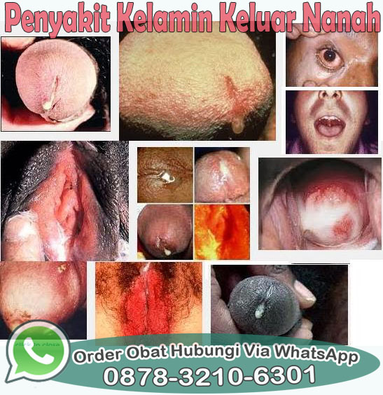 Obat Alami Untuk Mengobati Kencing Nanah Obat Alami Untuk Mengobati Kencing Nanah