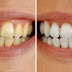 Simple Ways to Whiten Your Teeth Parmanently In Just Few Hours