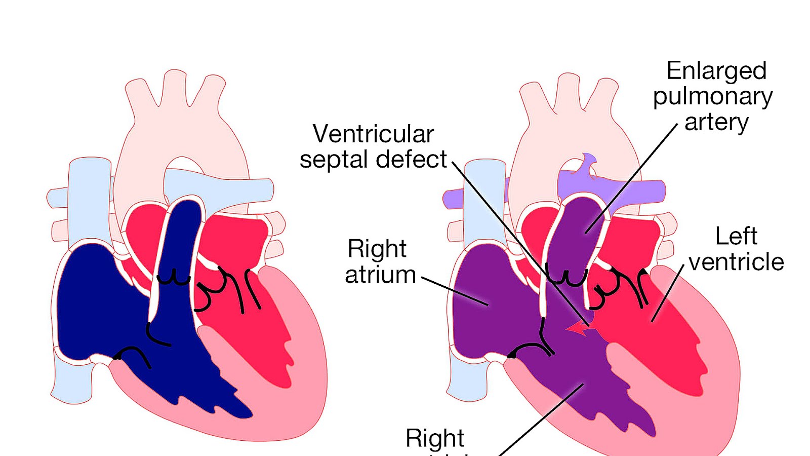 Vsd Heart Defect In Infants Hear Choices