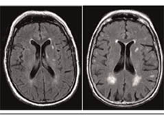 sutiles cambios en la sustancia blanca isquémica periventricular