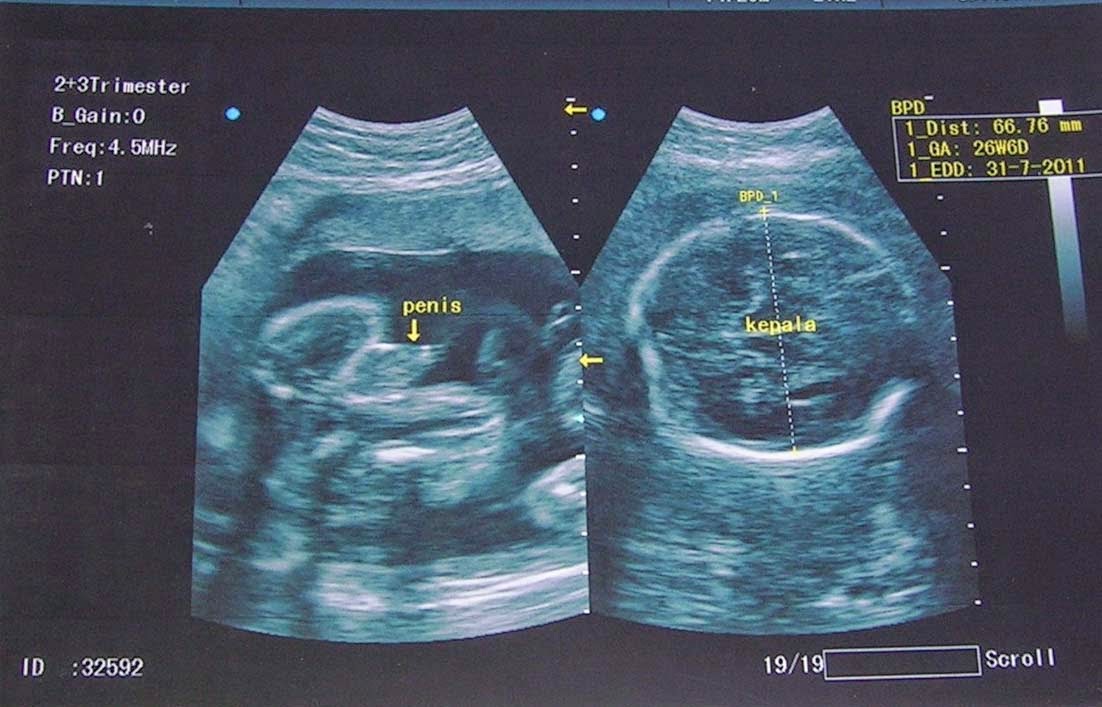 Memahami Investigasi Ultrasound (Usg) Pada ibu hamil