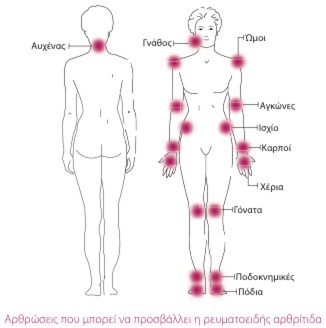 Σωστή διατροφή για αρθρίτιδα