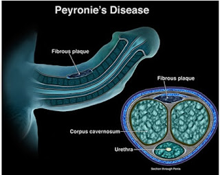 treatment for bend penis what does it mean when your penis is curved