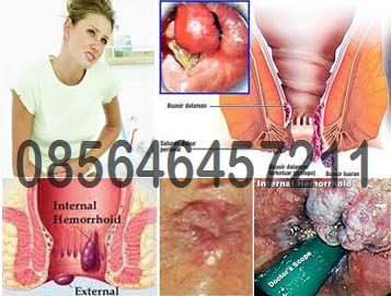 Obat AmbeJOSS Herbal dan Salep Wasir Obat AmbeJOSS Herbal dan Salep Wasir