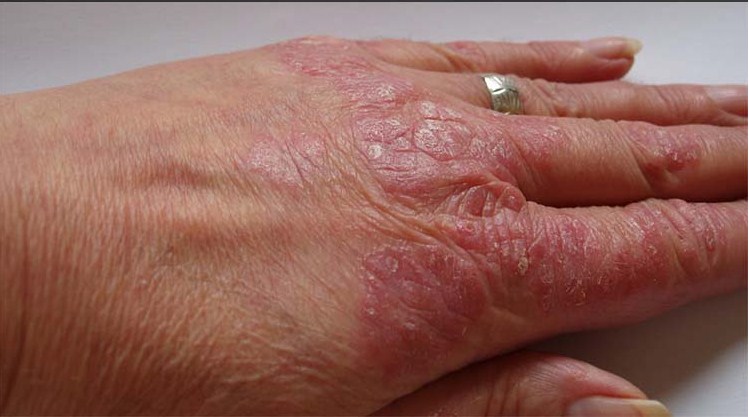 Emolium la crema especial y la psoriasis
