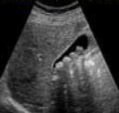 Ultrasound, ultrasonografi, ultrasonography, batu empedu, kolesterol, pigmen