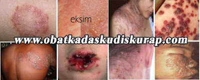 obat kudis obat kudis paling ampuh