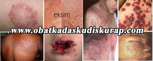 obat kadas obat kadas kudis kurap