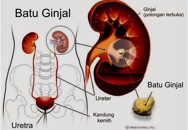 Baru Cara Mengobati Penyakit Batu Ginjal, Obat Sehat