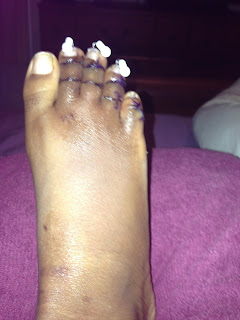 Hammertoe
