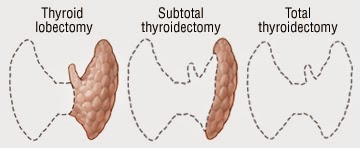 http://www.laparoscopic-general-surgery.com/head&neck-surgery-thyroidectomy.html