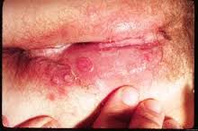 Foto obat herpes de nature