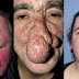 24 Personnes Touchées Par Une Infection Qui Transforme Le Nez En Patate