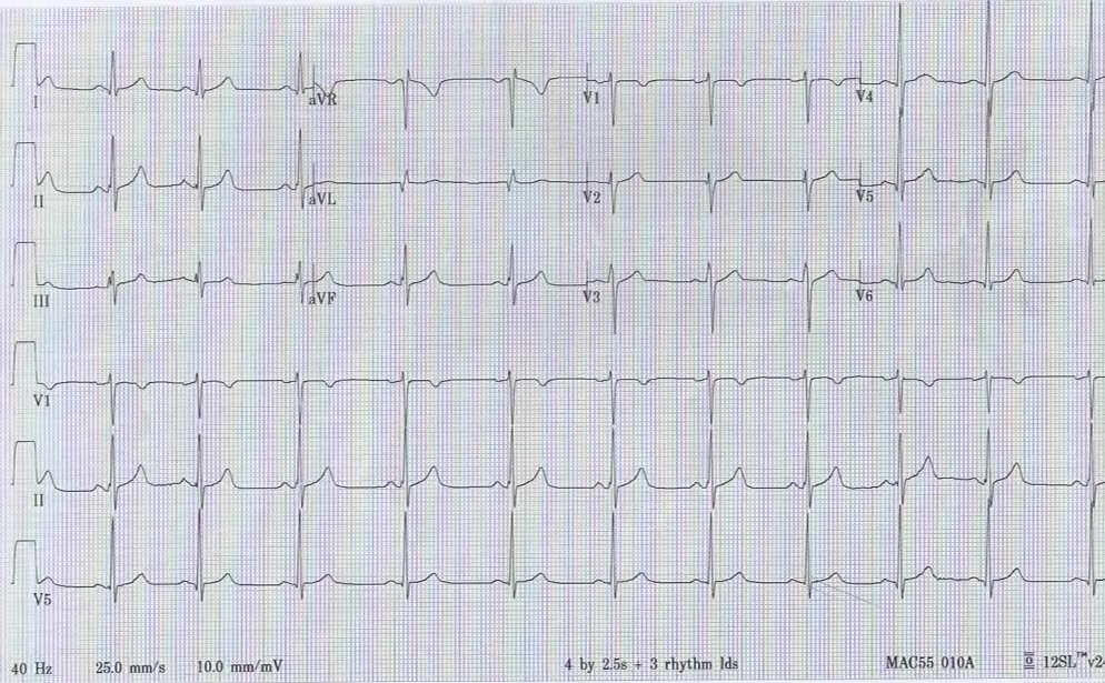 EM CaseLink Jiu Jitsu 1, Myocardium 0. Chest Pain After Jiu Jitsu Workout!