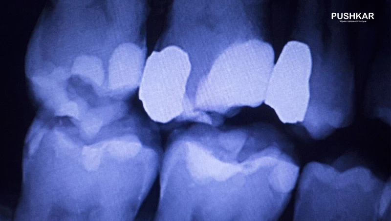 ВИТАМИН D – СЕКРЕТ ЗДОРОВЬЯ ЗУБОВ. ПРЕДОТВРАЩАЕТ И ЛЕЧИТ КАРИЕС.