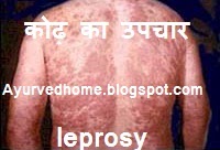 Leprosy Treatment at Home , कोढ़ का उपचार , kusth Rog Ka Illaj Upchaar