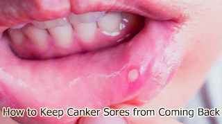 How to Keep Canker Sores from Coming Back