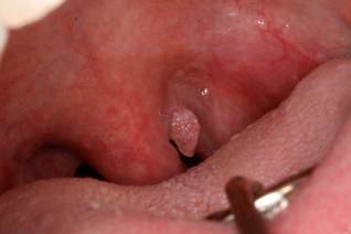Obat Sakit Kutil Kelamin