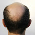 চুল পড়ার কারণ,প্রতিকার ও হোমিওপ্যাথি চিকিৎসা ( Hair Falling and its homeopathy treatment )