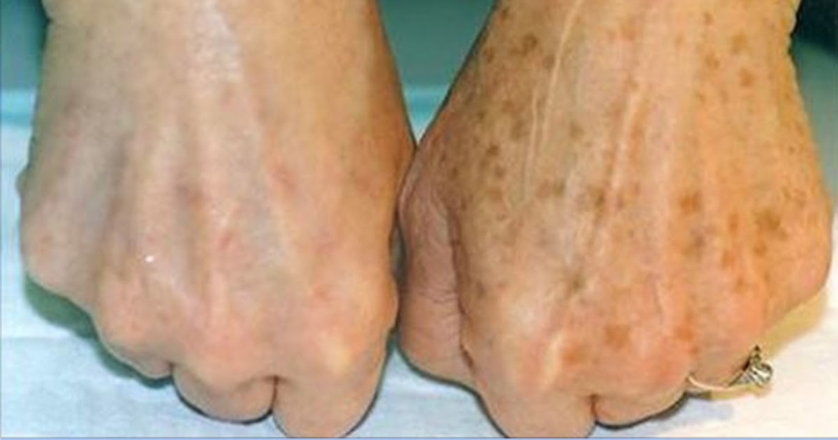 How To Remove Brown Aging Spots, The Easy And Natural Way The