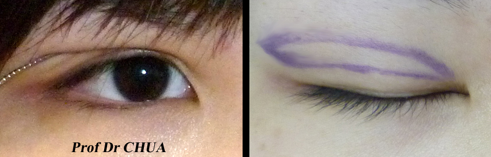 Eyelid Surgery by Prof Dr CN CHUA 蔡鐘能: Incision Method for Double Eyelid
