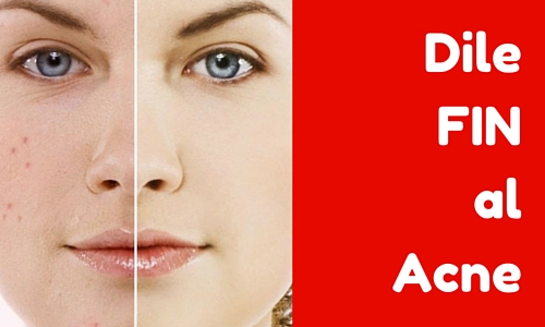 El acné por las infracciones endocrinas