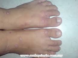 obat gatal kulit: Cara Menghilangkan Gatal Eksim Pada ...