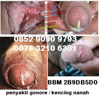 Testimoni Pengobatan Kelamin Keluar Nanah Testimoni Pengobatan Kelamin Keluar Nanah