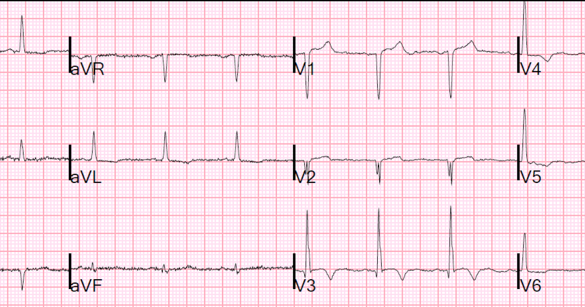 Dr. Smith's ECG Blog One reason we get ECGs in stroke patients