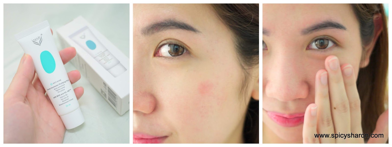 NUViT Anti-Acne Series Acne Corrector Purifying Fluid Malaysia Review