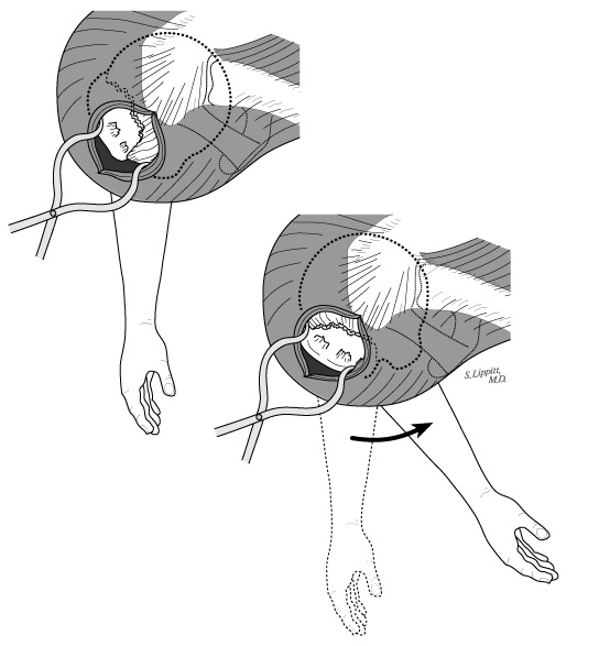 UW Shoulder and Elbow Academy: Rotator Cuff 11 - Surgery for rotator ...
