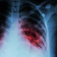 Tuberculosis treatment