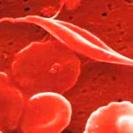 Sickled Red Blood Cells