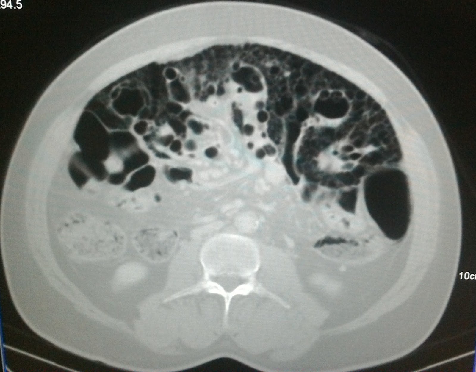 Air bubbles everywhere in the abdomen
