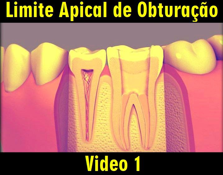 ENDODONTIA Limite Apical de Obturação Video 1