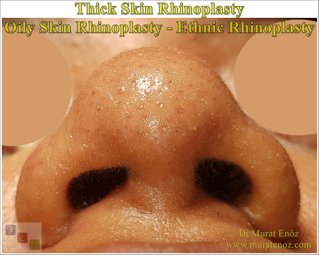 Thick Skin Rhinoplasty - Oily Skin Rhinoplasty - Ethnic Rhinoplasty