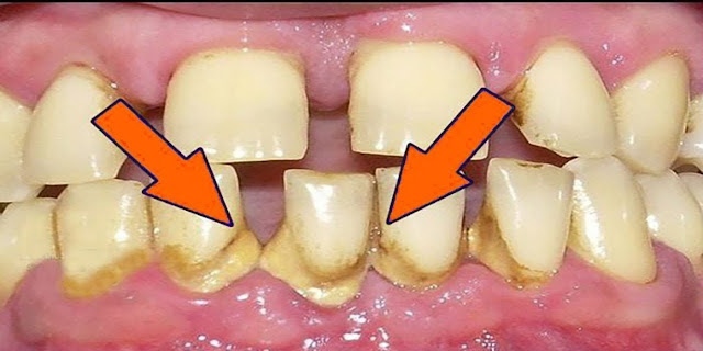 Cómo quitar el SARRO de los Dientes en 5 minutos sin ir al dentista