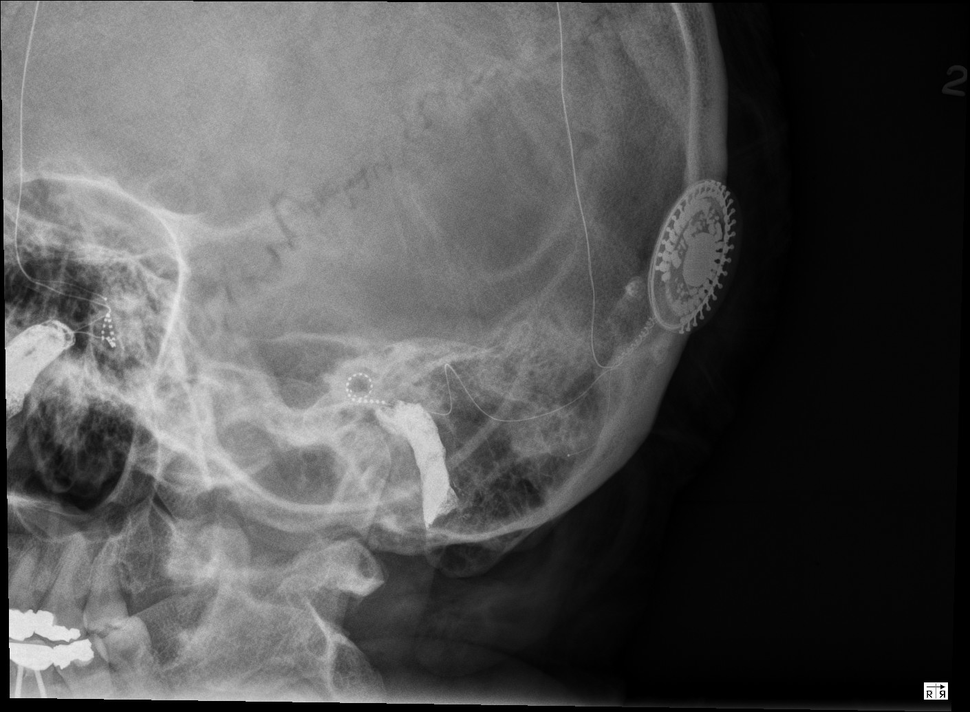 Living with a Neurelec Cochlear Implant by Lisa B R and R / Xrays!