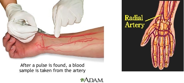 Laboratorium Analis Kesehatan: Cara Pengambilan Darah Arteri
