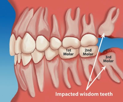 Manfaat Gigi Bungsu Yang Perlu Anda Ketahui