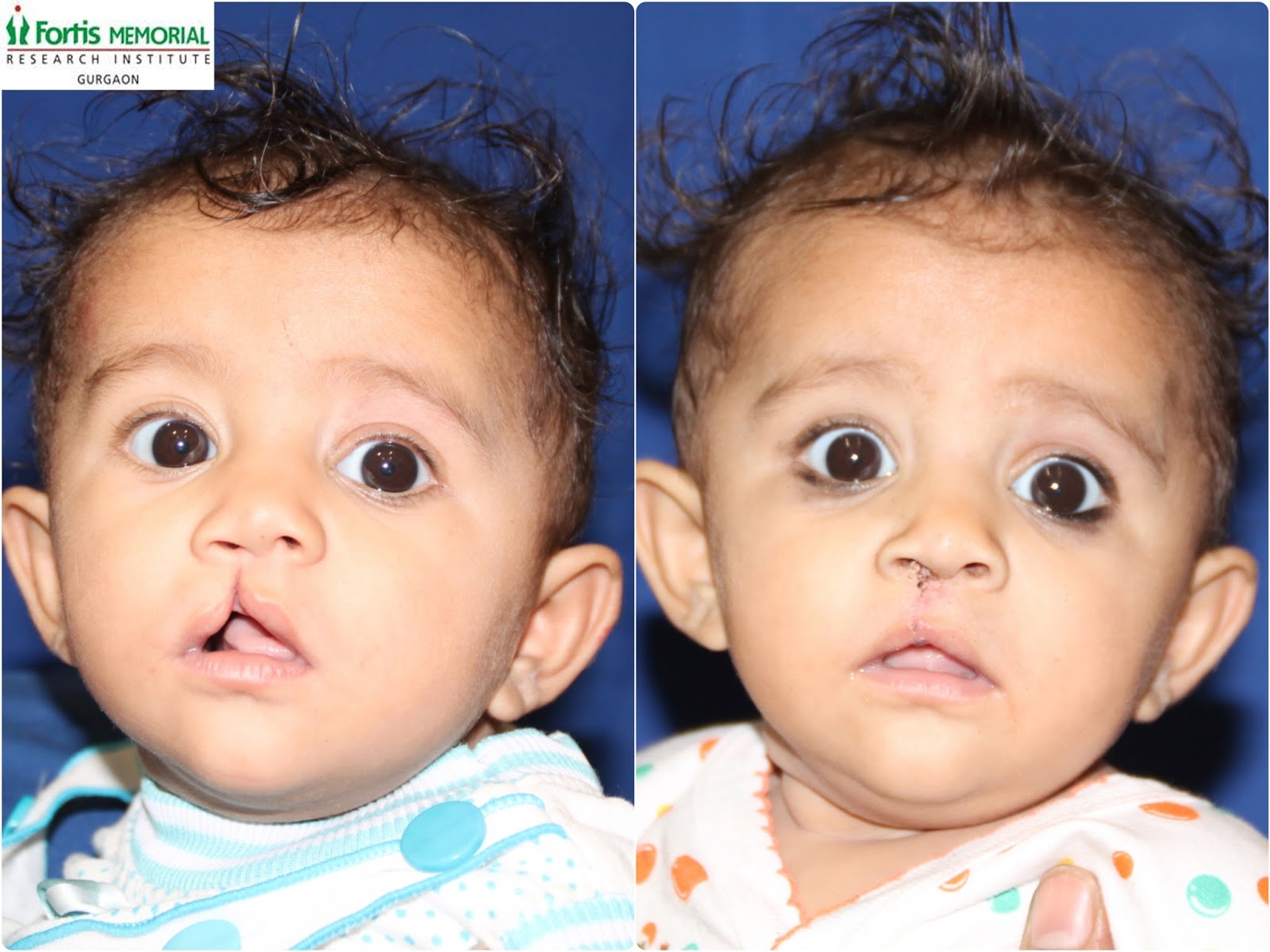 Free Cleft Lip And Palate Surgery In Delhi June 2015