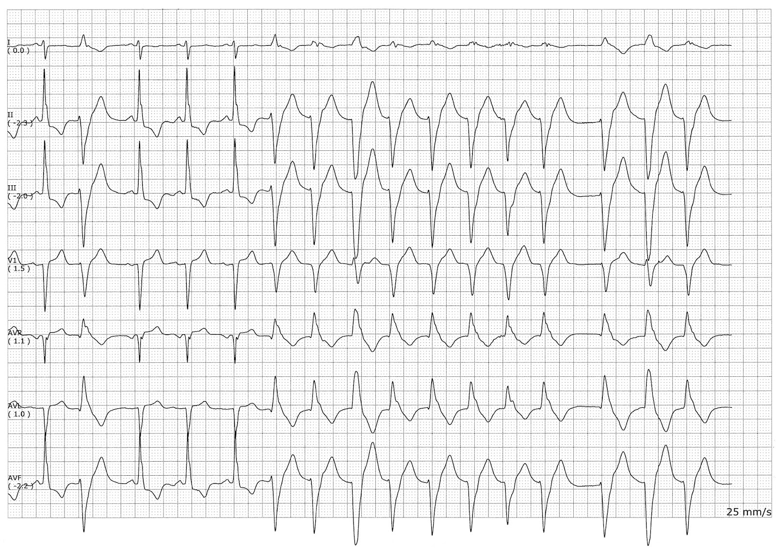 sinus rhythm ivcd sinus rhythm ivcd