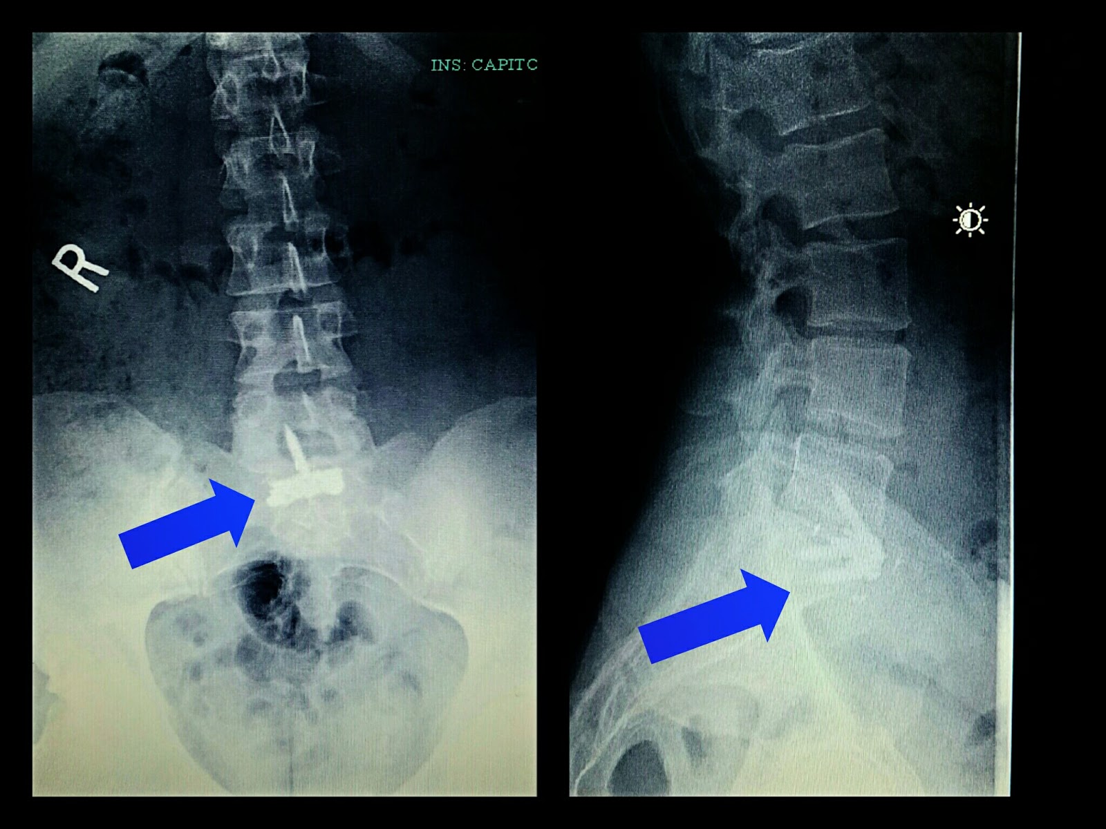 4 Weeks PostOp of a L5S1 Fusion FatGirl vs World