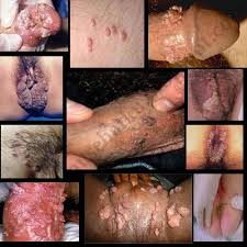 Berapa Harga Obat Kutil Kelamin Gangjie Ghosiah Di Labuhanbatu Utara Aek Kanopan Sumatera Utara Berapa Harga Obat Kutil Kelamin Gangjie Ghosiah Di Labuhanbatu Utara Aek Kanopan Sumatera Utara