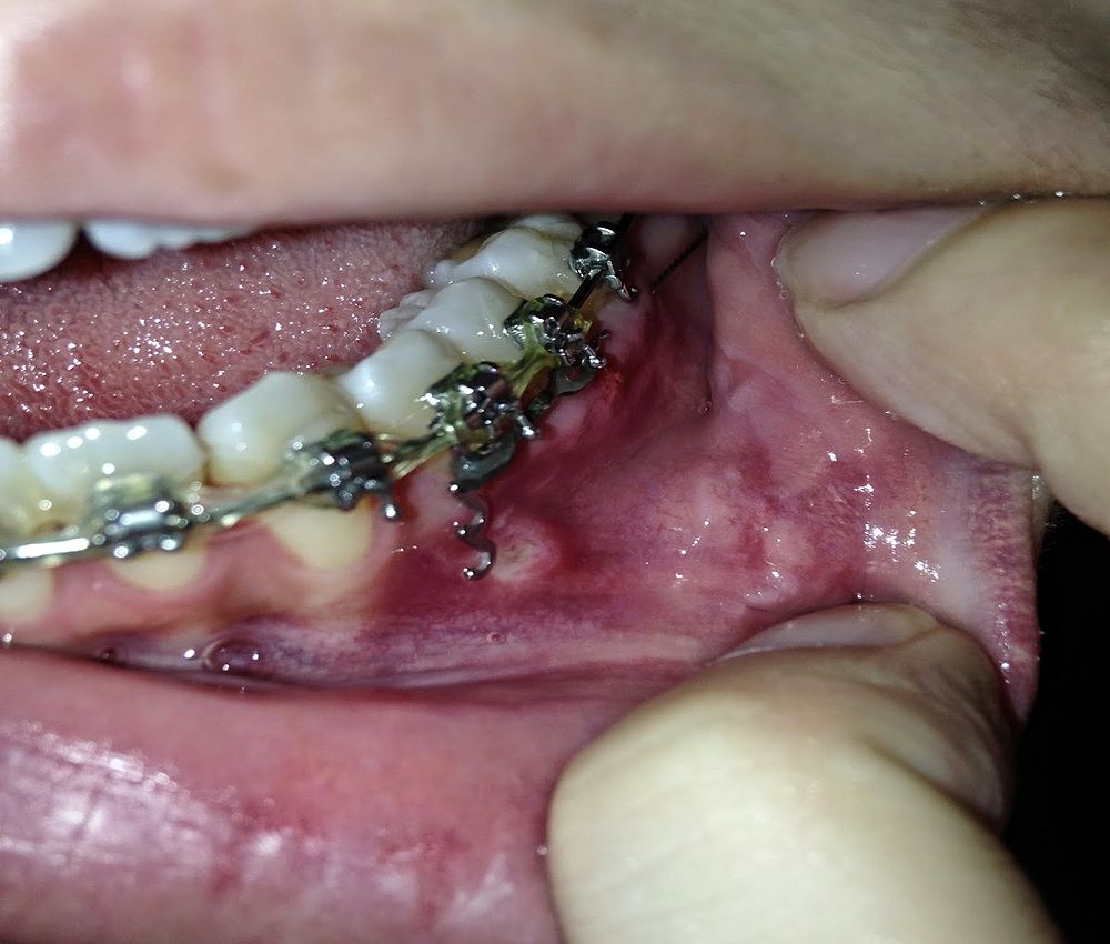 Orthodontic Injury